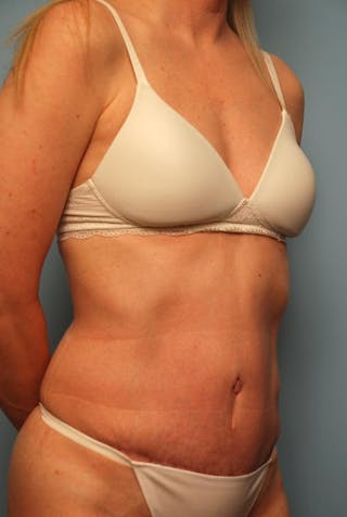 Tummy Tuck Before & After Gallery - Patient 494956 - Image 4