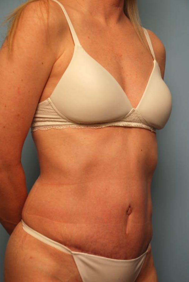 Tummy Tuck Before & After Gallery - Patient 494956 - Image 4