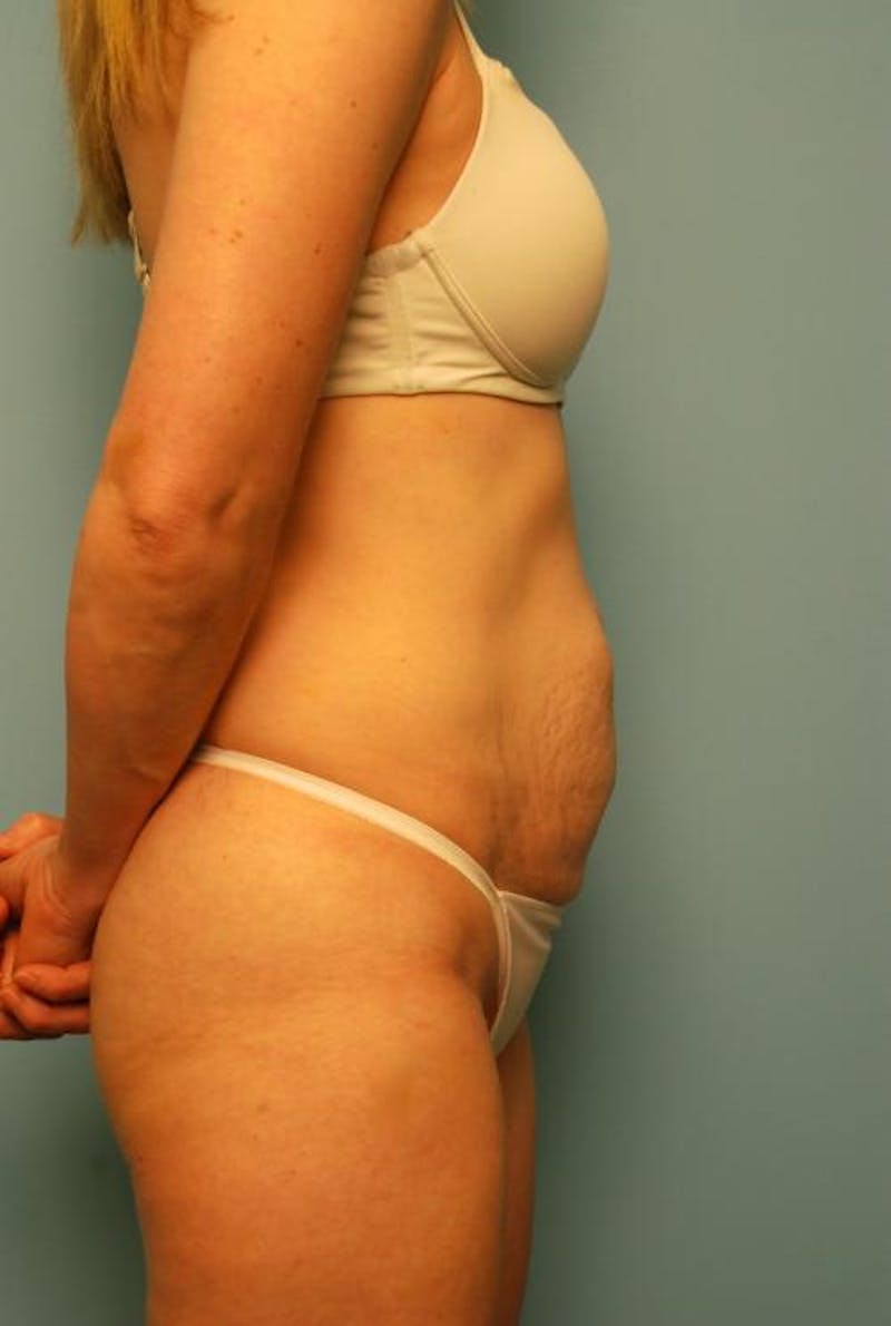 Tummy Tuck Before & After Gallery - Patient 494956 - Image 5