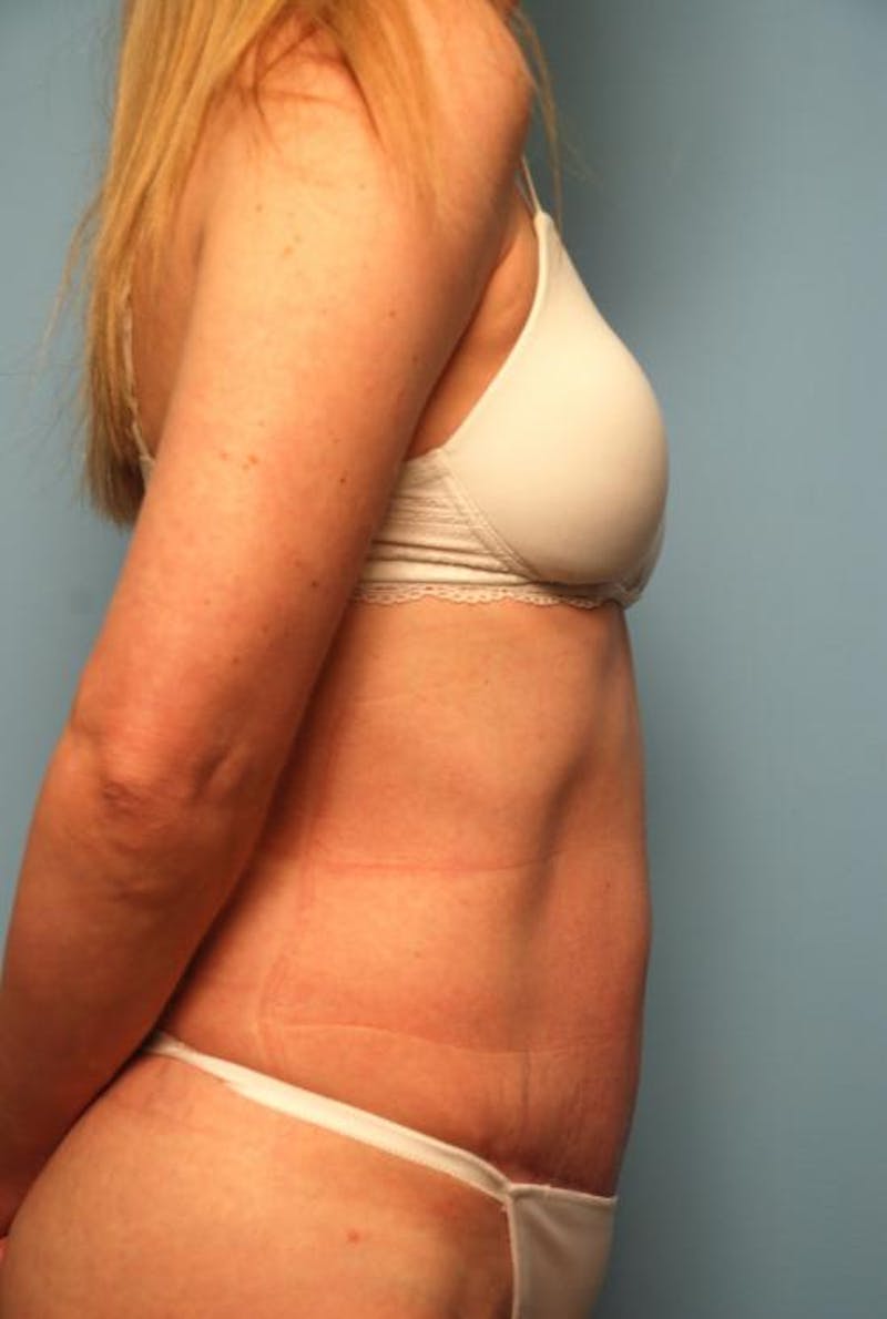 Tummy Tuck Before & After Gallery - Patient 494956 - Image 6