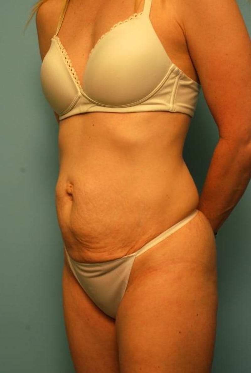 Tummy Tuck Before & After Gallery - Patient 494956 - Image 7