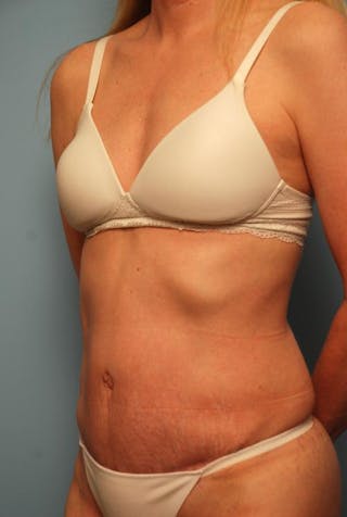 Tummy Tuck Before & After Gallery - Patient 494956 - Image 8