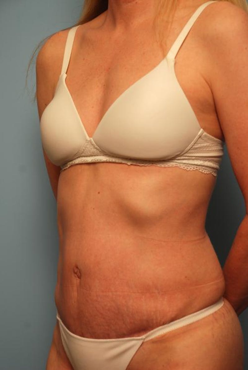 Tummy Tuck Before & After Gallery - Patient 494956 - Image 8
