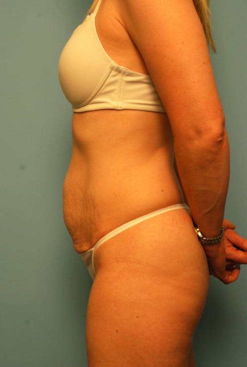 Tummy Tuck Before & After Gallery - Patient 494956 - Image 9