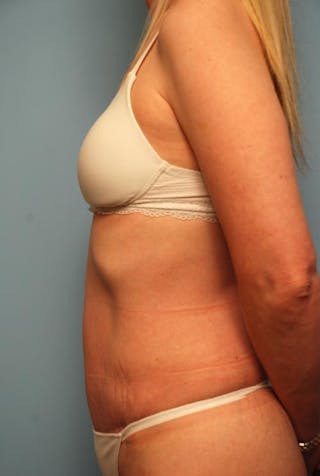 Tummy Tuck Before & After Gallery - Patient 494956 - Image 10