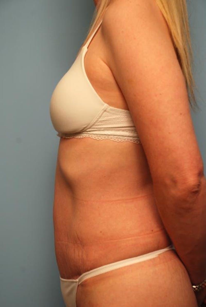 Tummy Tuck Before & After Gallery - Patient 494956 - Image 10