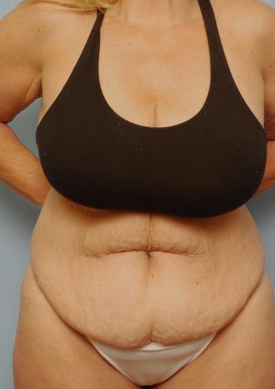 Tummy Tuck Before & After Gallery - Patient 412567 - Image 1