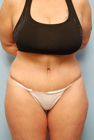 Tummy Tuck Before & After Gallery - Patient 161435 - Image 2