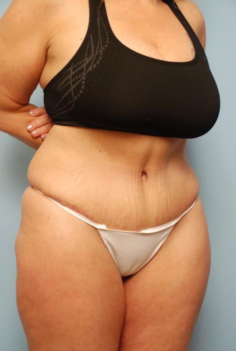 Tummy Tuck Before & After Gallery - Patient 161435 - Image 4