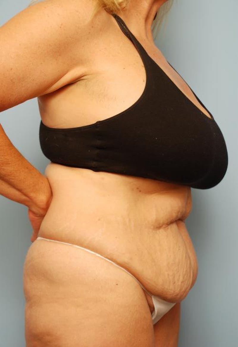Tummy Tuck Before & After Gallery - Patient 161435 - Image 5