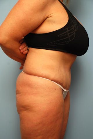 Tummy Tuck Before & After Gallery - Patient 161435 - Image 6