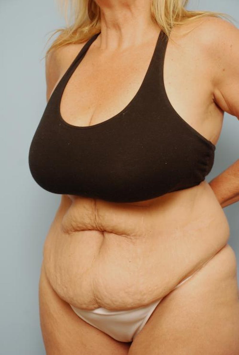 Tummy Tuck Before & After Gallery - Patient 161435 - Image 7