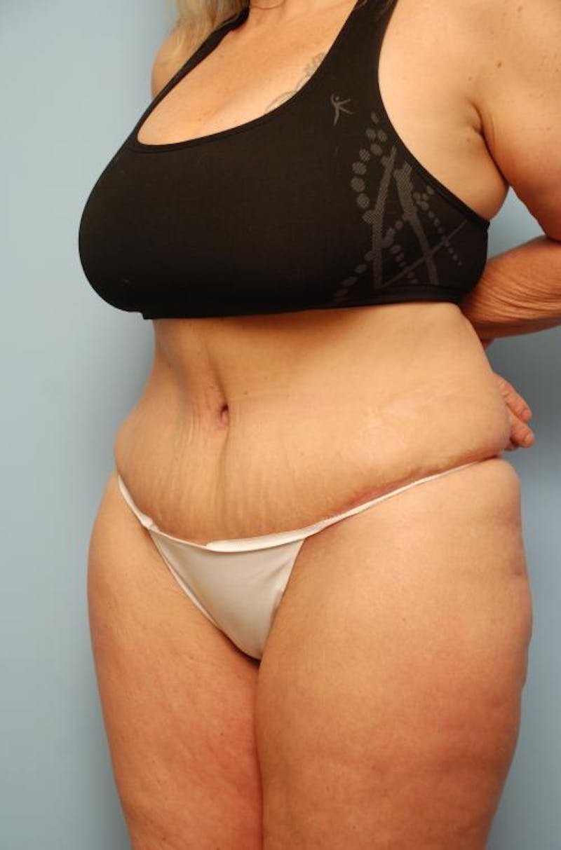 Tummy Tuck Before & After Gallery - Patient 161435 - Image 8