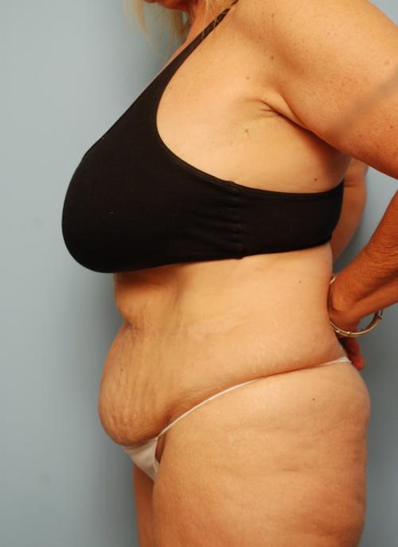 Tummy Tuck Before & After Gallery - Patient 161435 - Image 9
