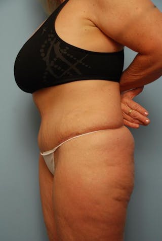Tummy Tuck Before & After Gallery - Patient 161435 - Image 10