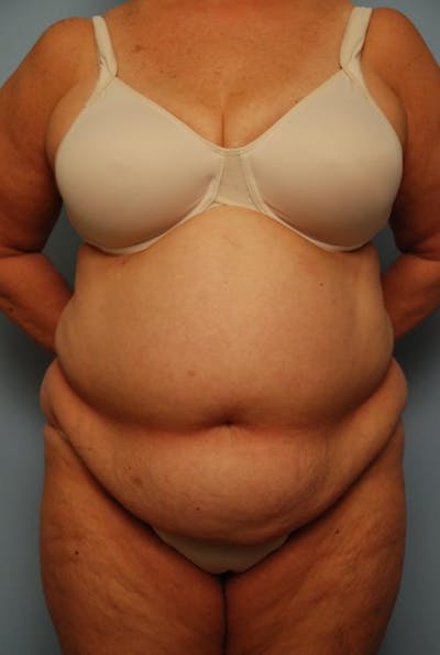 Tummy Tuck Before & After Gallery - Patient 341507 - Image 1