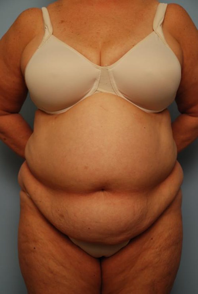 Tummy Tuck Before & After Gallery - Patient 308695 - Image 1