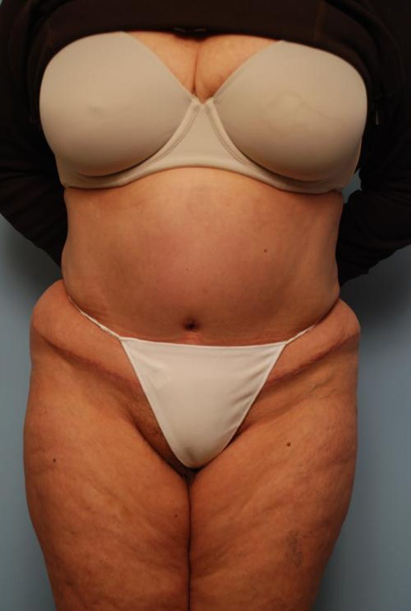 Tummy Tuck Before & After Gallery - Patient 308695 - Image 2