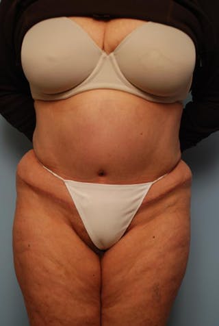Tummy Tuck Before & After Gallery - Patient 308695 - Image 2