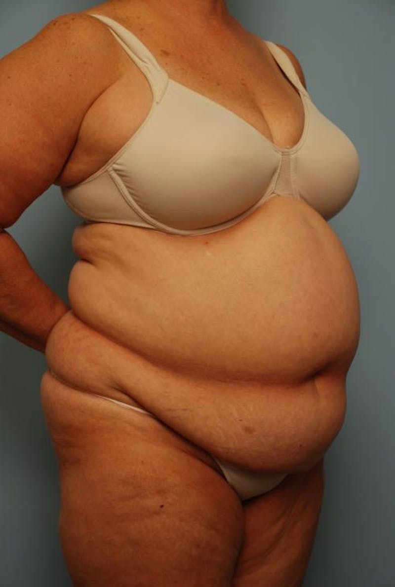 Tummy Tuck Before & After Gallery - Patient 308695 - Image 3