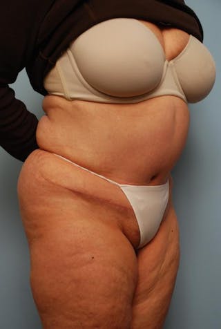 Tummy Tuck Before & After Gallery - Patient 308695 - Image 4