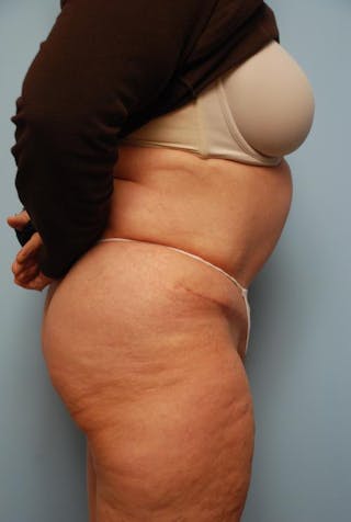 Tummy Tuck Before & After Gallery - Patient 308695 - Image 6