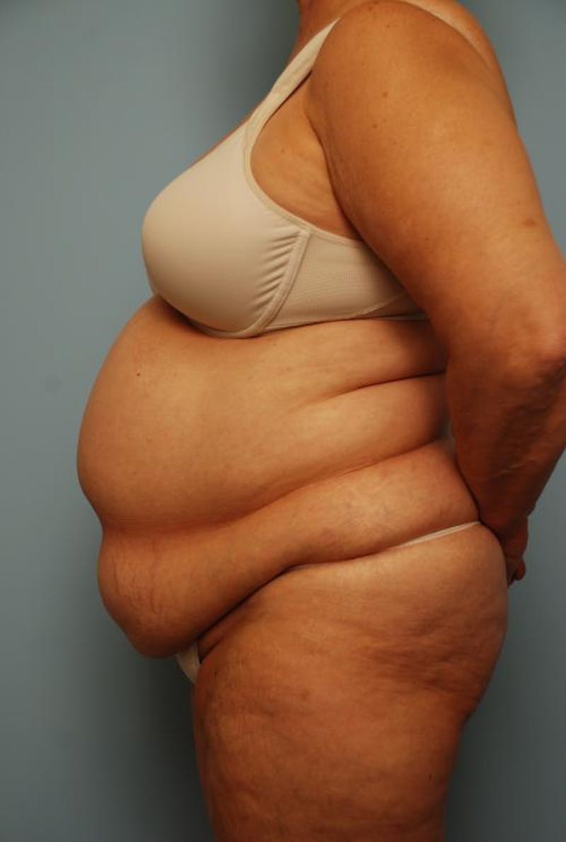 Tummy Tuck Before & After Gallery - Patient 308695 - Image 9
