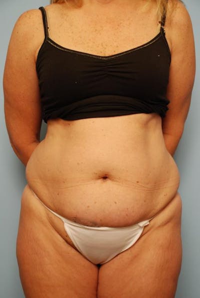 Tummy Tuck Before & After Gallery - Patient 161334 - Image 1
