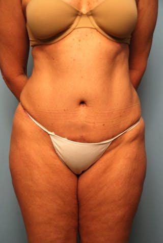 Tummy Tuck Before & After Gallery - Patient 108810 - Image 2