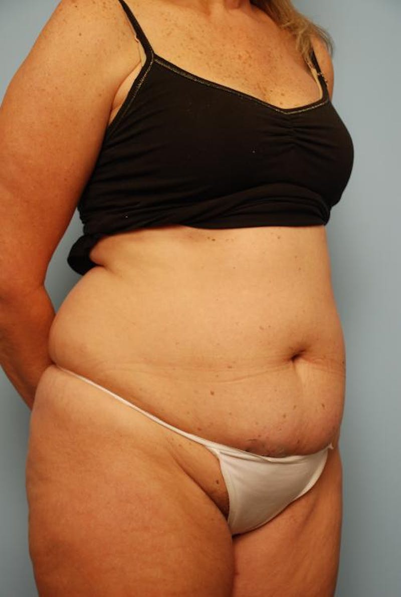 Tummy Tuck Before & After Gallery - Patient 108810 - Image 3