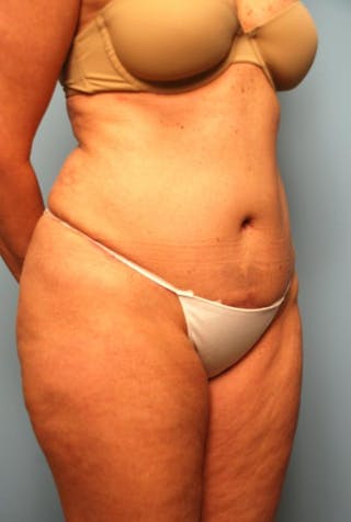 Tummy Tuck Before & After Gallery - Patient 108810 - Image 4