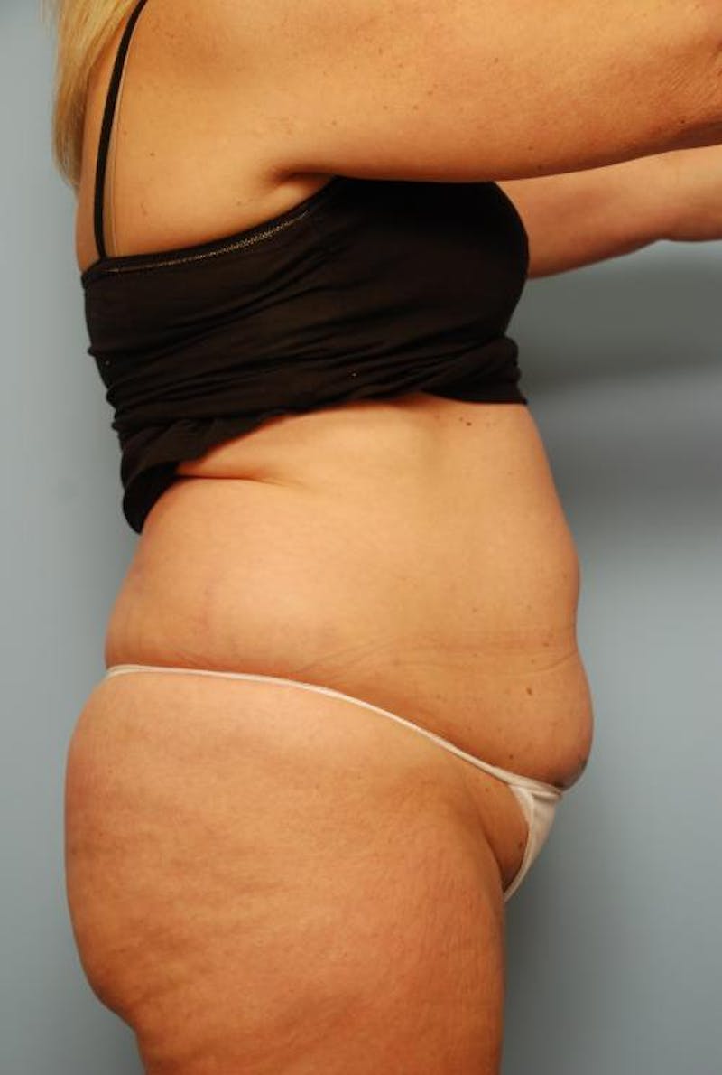 Tummy Tuck Before & After Gallery - Patient 108810 - Image 5