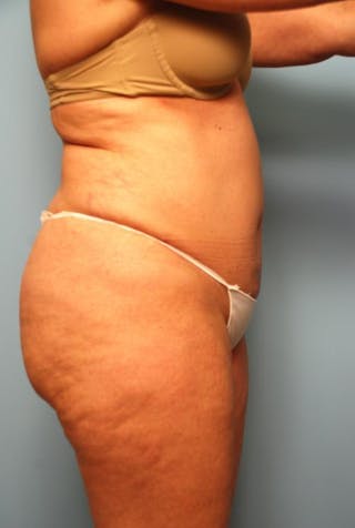 Tummy Tuck Before & After Gallery - Patient 108810 - Image 6