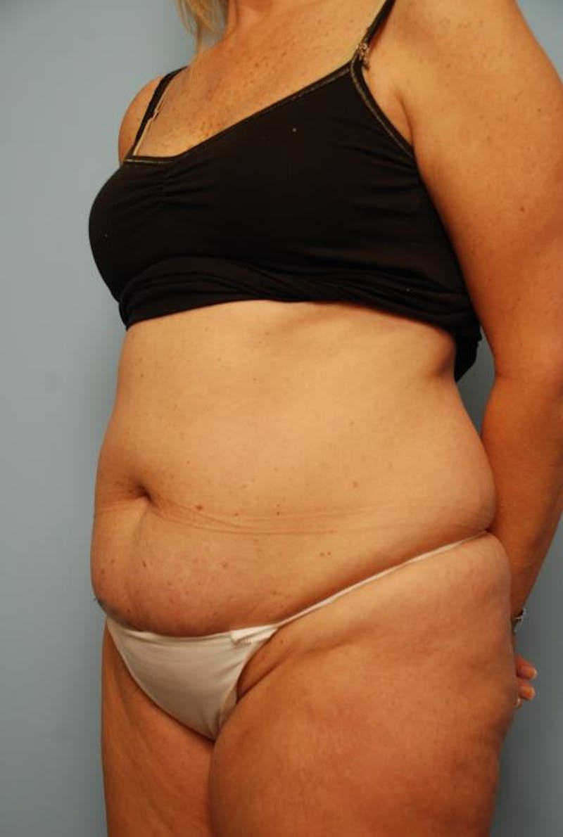 Tummy Tuck Before & After Gallery - Patient 108810 - Image 7