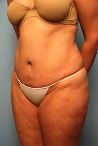 Tummy Tuck Before & After Gallery - Patient 108810 - Image 8
