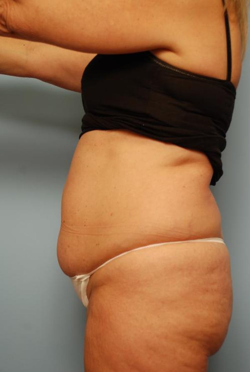 Tummy Tuck Before & After Gallery - Patient 108810 - Image 9