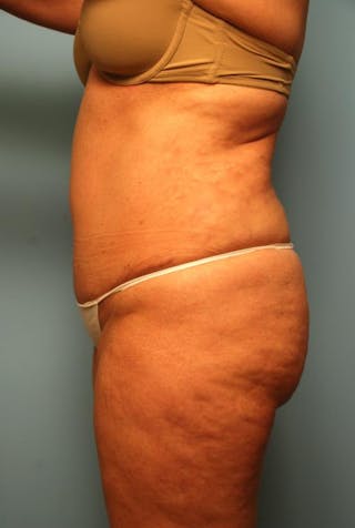 Tummy Tuck Before & After Gallery - Patient 108810 - Image 10