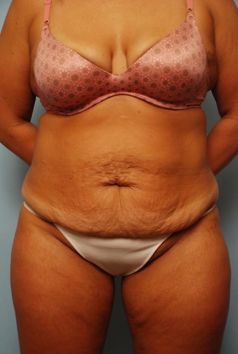 Tummy Tuck Before & After Gallery - Patient 209208 - Image 1