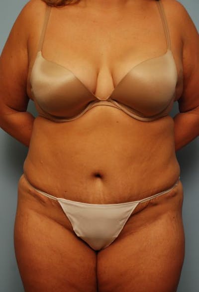 Tummy Tuck Before & After Gallery - Patient 209208 - Image 2
