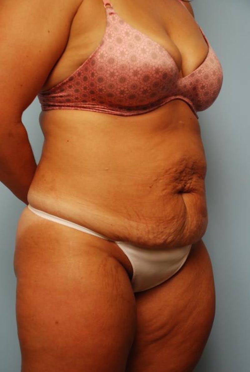Tummy Tuck Before & After Gallery - Patient 209208 - Image 3