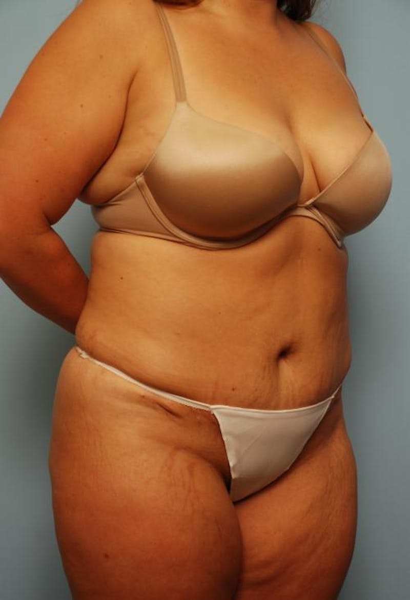Tummy Tuck Before & After Gallery - Patient 209208 - Image 4