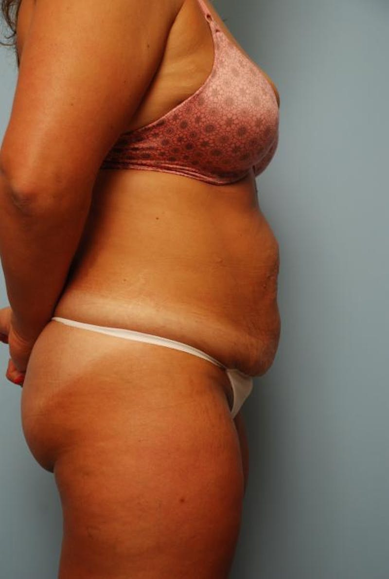 Tummy Tuck Before & After Gallery - Patient 209208 - Image 5