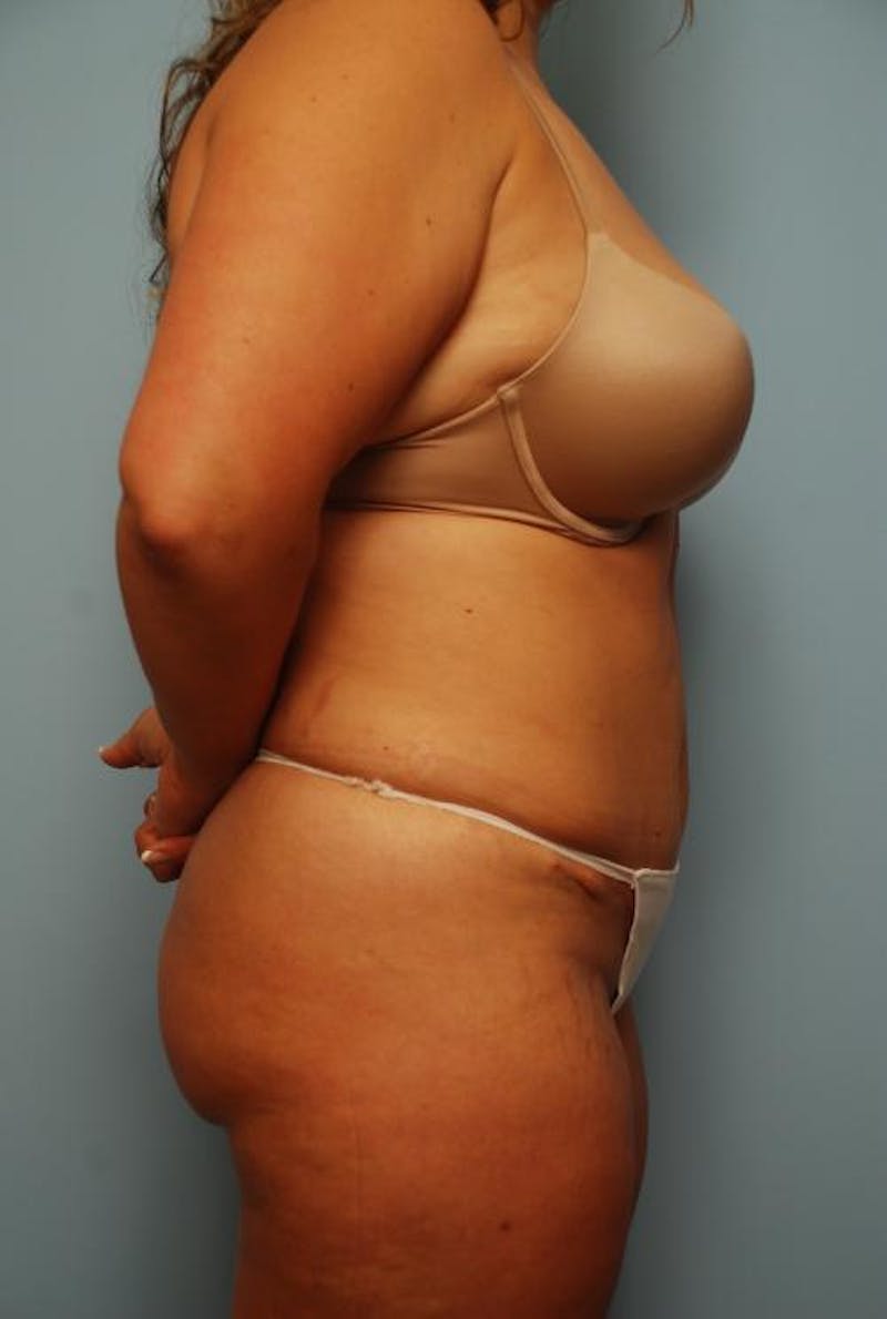 Tummy Tuck Before & After Gallery - Patient 209208 - Image 6