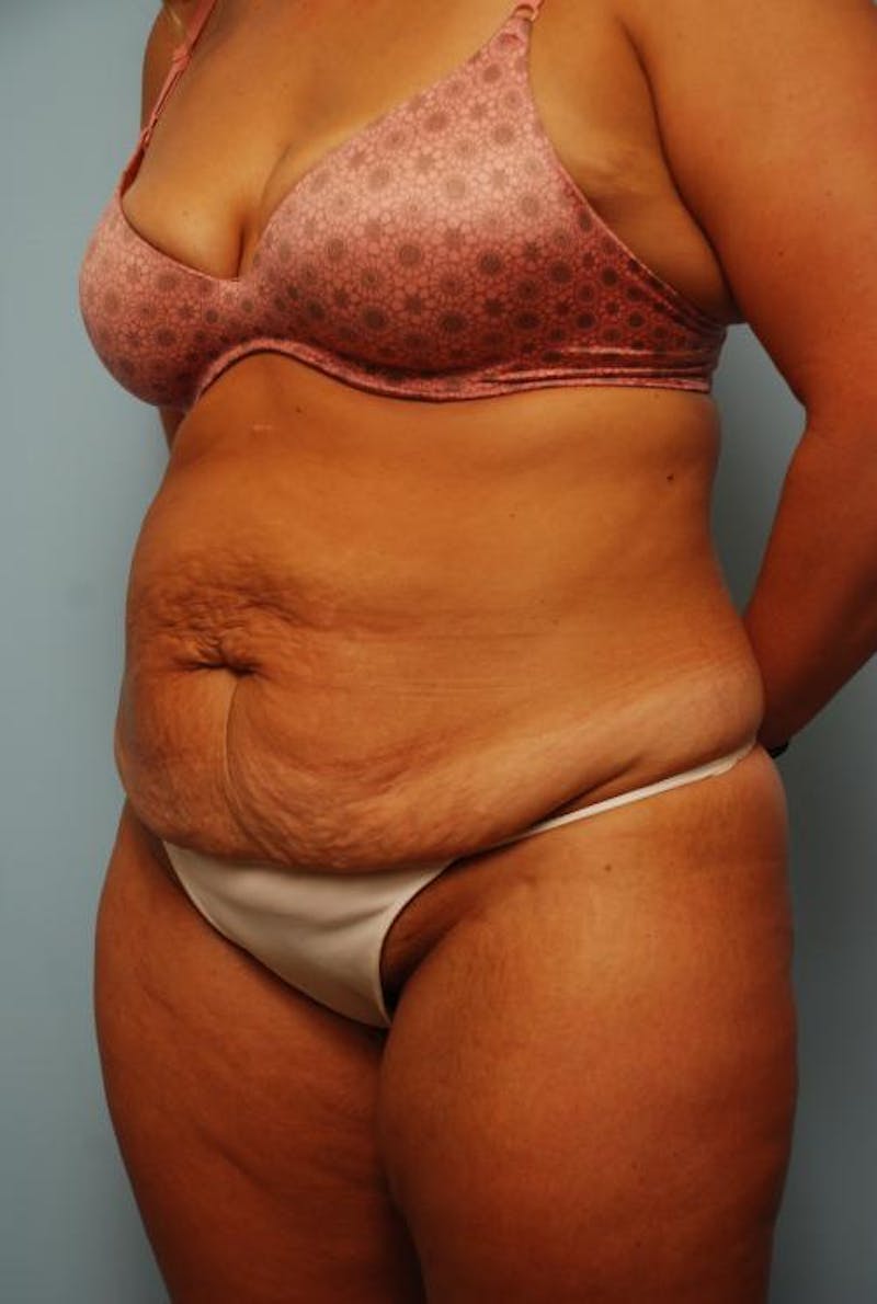 Tummy Tuck Before & After Gallery - Patient 209208 - Image 7