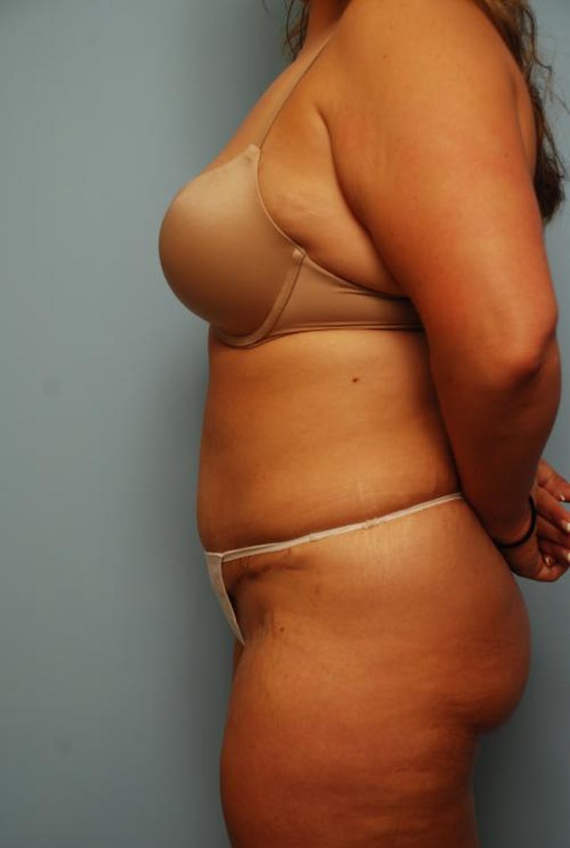 Tummy Tuck Before & After Gallery - Patient 209208 - Image 10