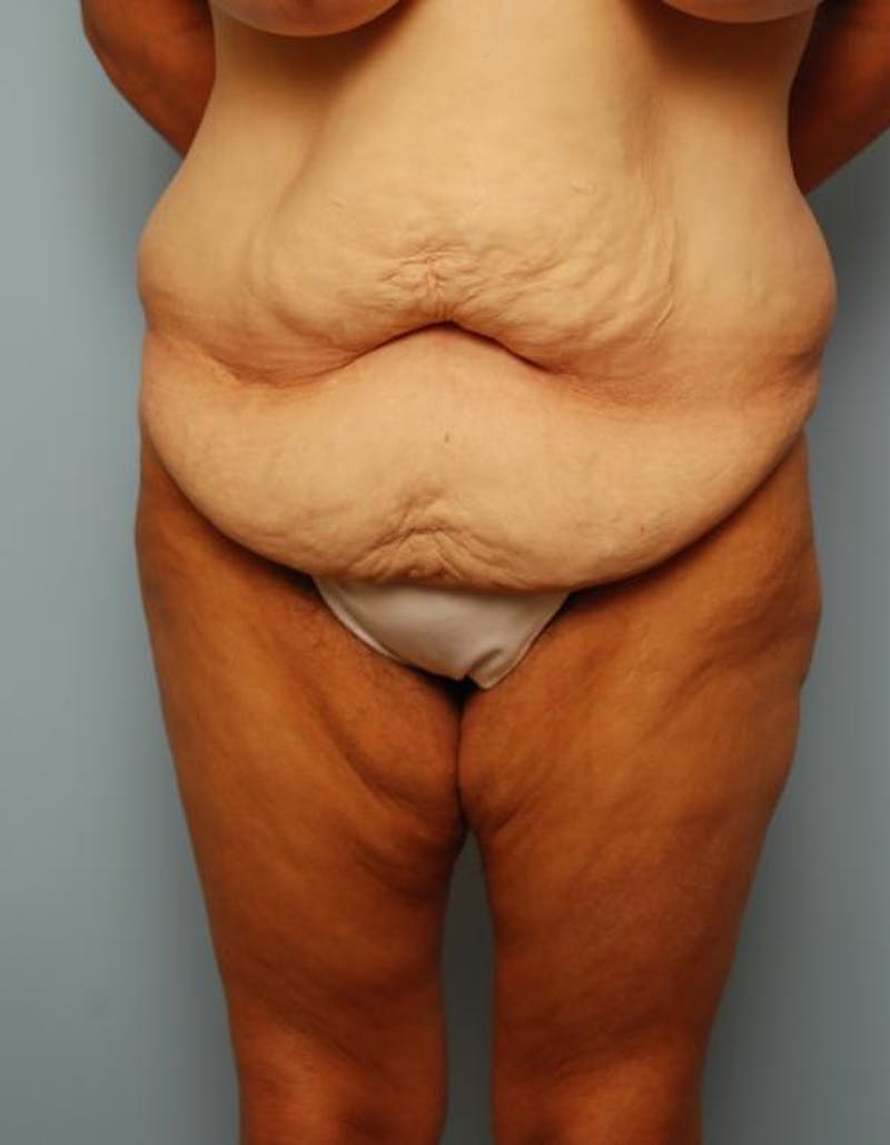 Tummy Tuck Before & After Gallery - Patient 392265 - Image 1