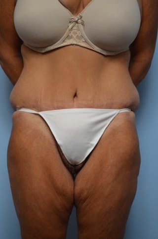 Tummy Tuck Before & After Gallery - Patient 392265 - Image 2