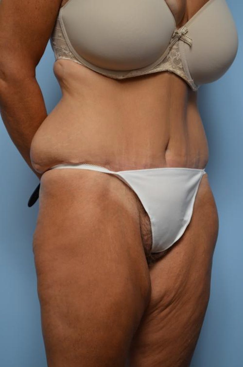 Tummy Tuck Before & After Gallery - Patient 392265 - Image 4