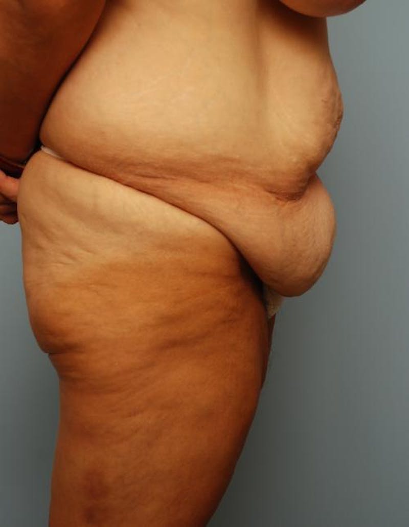 Tummy Tuck Before & After Gallery - Patient 392265 - Image 5