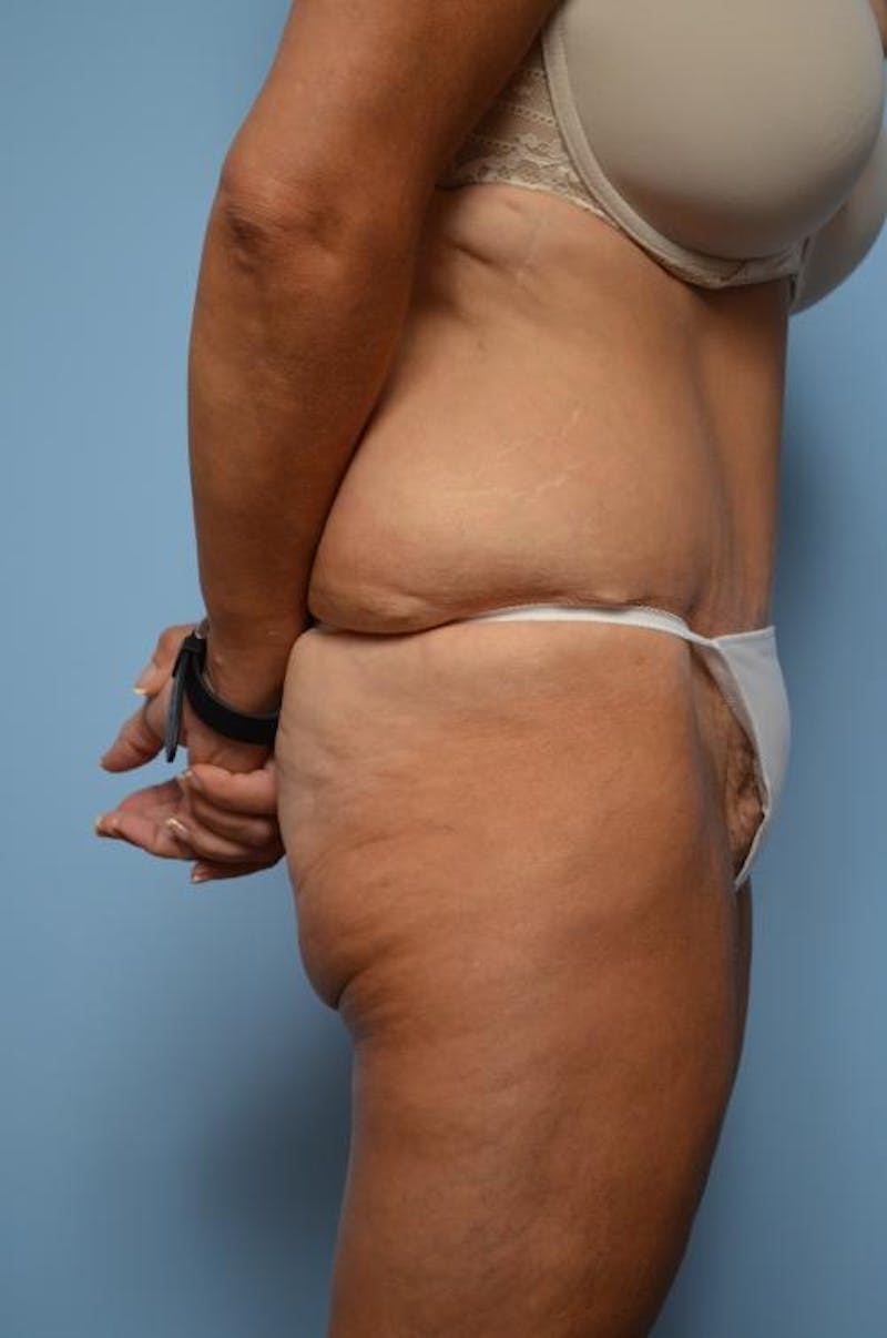 Tummy Tuck Before & After Gallery - Patient 392265 - Image 6